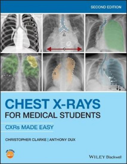 Picture of Chest X-Rays for Medical Students: CXRs Made Easy 2ed